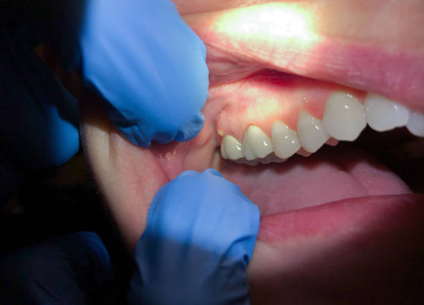 Best Emergency Treatment for Dental Infections or Abscesses in Ferdand, IN